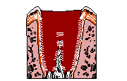 УдаСгусток крови, оставшийся после Удаление зуба, способствующий заживлению